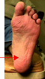 plantarfascitis.gif (11317 bytes)